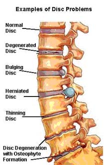 degernative disc disease